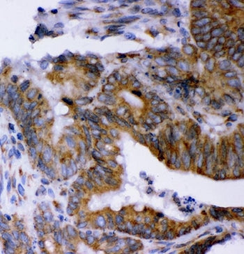 IHC staining of FFPE human colorectal adenocarcinoma tissue with AEG-1 antibody. HIER: boil tissue s