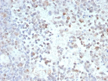 IHC staining of FFPE human melanoma tissue with Opa-interacting protein 4 antibody (clone PRAME/9189