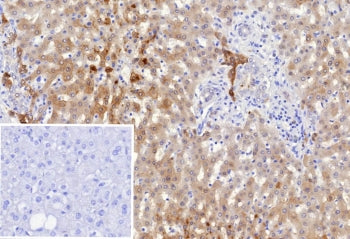 IHC staining of FFPE human hepatocellular carcinoma tissue with Dihydrodiol dehydrogenase 1 antibody