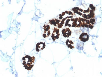 IHC testing of FFPE human basal cell carcinoma with Cytokeratin 15 antibody (clone KRT15/2554). Requ