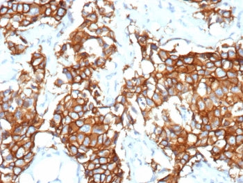 IHC staining of FFPE human breast cancer tissue with recombinant ErbB2 antibody (clone rERBB2/9538).