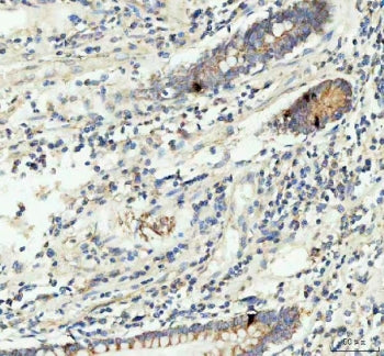 IHC staining of FFPE human colorectal adenocarcinoma tissue with GIP antibody. HIER: boil tissue sec