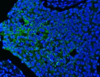 Immunofluorescent staining of FFPE human esophageal squamous cell carcinoma tissue with PITPNB antib