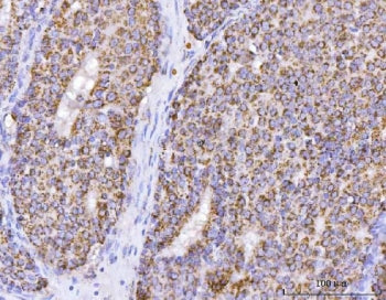 IHC staining of FFPE human breast cancer with ATP5F1B antibody. HIER: boil tissue sections in pH6, 1