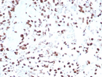 IHC staining of FFPE human bladder tissue with MDM2 antibody (clone MDM2/7943). HIER: boil tissue se