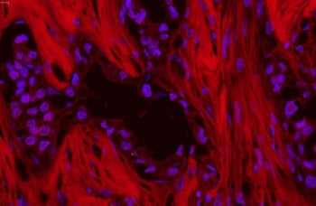Immunofluorescent staining of human lung cancer tissue with p62 antibody (red) at 1ug/ml and DAPI co