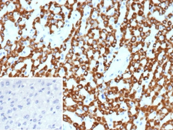 IHC staining of FFPE human hepatocellular carcinoma tissue with CPS1 antibody (clone CPS1/9859). Ins