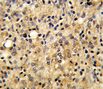 IHC testing of FFPE human prostate carcinoma tissue with TSP5 antibody. HIER: steam section in pH6 c