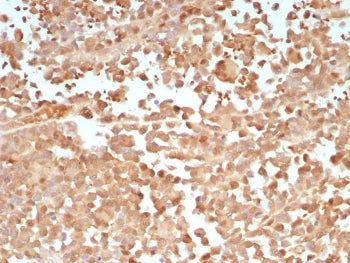 IHC staining of FFPE human melanoma tissue with PRAME antibody (clone PRAME/9188). HIER: boil tissue
