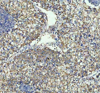 IHC staining of FFPE human lung cancer tissue with TOMM20 antibody. HIER: boil tissue sections in pH