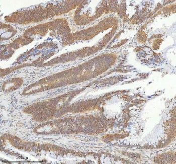 IHC staining of FFPE human colon adenocarcinoma tissue with METTL18 antibody. HIER: boil tissue sect