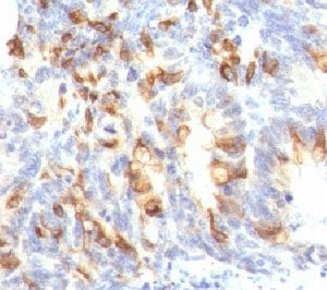IHC: Formalin-fixed, paraffin-embedded human colon carcinoma stained with MUC2 antibody (clone MLP/8