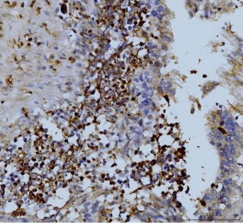 IHC staining of FFPE human colon adenocarcinoma with MMP9 antibody. HIER: boil tissue sections in pH