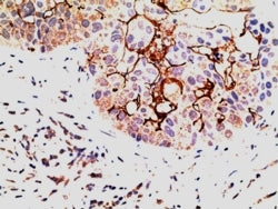 IHC testing of FFPE human breast carcinoma with EPS8 antibody at 5ug/ml. HIER: steamed with pH6 citr