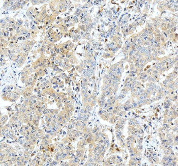Immunohistochemical staining of GSTO1 using anti-GSTO1 antibody. GSTO1 was detected in a paraffin-em