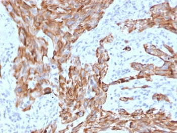 IHC staining of FFPE human lung carcinoma with Cytokeratin 7 antibody (clone KRT7/2200). HIER: boil