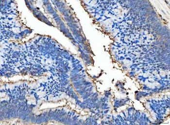 IHC staining of FFPE human colorectal adenocarcinoma tissue with MFG-E8 antibody. HIER: boil tissue
