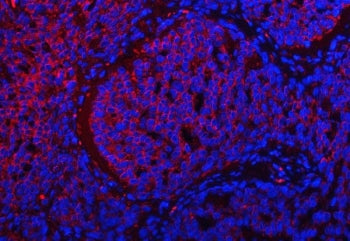 Immunofluorescent staining of FFPE human lung squamous cell carcinoma with TRMT2B antibody (red) and