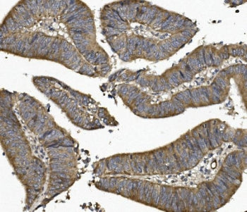 IHC staining of FFPE human rectal cancer with UNG antibody. HIER: boil tissue sections in pH8 EDTA f