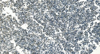 IHC staining of FFPE human testicular cancer with PI16 antibody. HIER: boil tissue sections in pH8 E