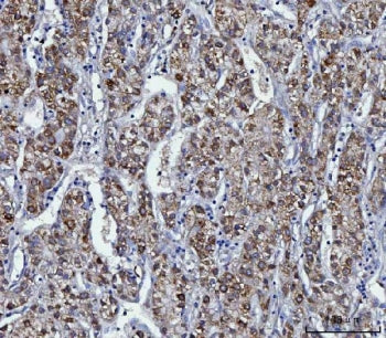 IHC staining of FFPE human liver cancer tissue with KMO antibody. HIER: boil tissue sections in pH8