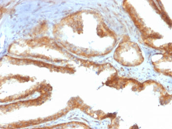 IHC staining of FFPE human prostate carcinoma with recombinant YB-1 antibody (clone rYBX1/2430). HIE