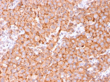 IHC staining of FFPE human urothelial carcinoma with UPK1B antibody. HIER: boil tissue sections in p