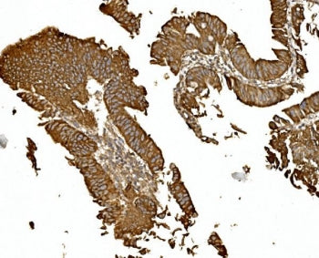 IHC staining of FFPE human rectal cancer with BDH1 antibody. HIER: boil tissue sections in pH8 EDTA