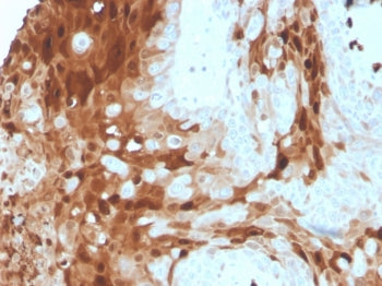 IHC staining of FFPE human breast cancer tissue with S100A9 antibody (clone S100A9/1075). HIER: boil