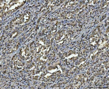 IHC staining of FFPE human gastric carcinoma tissue with hnRNP U antibody. HIER: boil tissue section