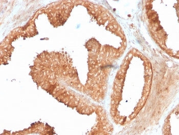 IHC staining of FFPE human prostate carcinoma with recombinant ODC1 antibody (clone ODC1/3636R). HIE