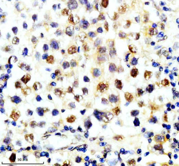 Immunohistochemical staining of SLX4 using anti-SLX4 antibody. SLX4 was detected in a paraffin-embed