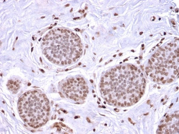 IHC testing of FFPE human breast carcinoma stained with recombinant Mammaglobin antibody (clone MGB/