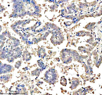 Immunohistochemical staining of ASCL1 using anti-ASCL1 antibody. ASCL1 was detected in a paraffin-em
