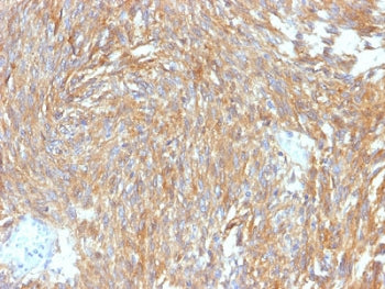 IHC testing of FFPE human gastrointestinal stromal tumor (GIST) with DOG1 antibody (clone DG1/2564R)