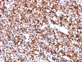 IHC: Formalin-fixed, paraffin-embedded human renal cell carcinoma stained with CAIX antibody (CA9/78