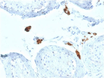 IHC testing of FFPE human testicular carcinoma with CALB2 antibody. HIER: boil tissue sections in pH