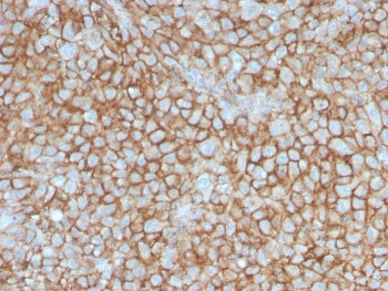 IHC staining of FFPE human melanoma with MCAM antibody. HIER: boil tissue sections in pH 9 10mM Tris