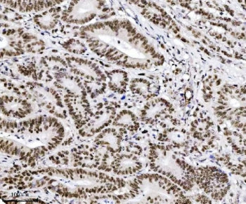 IHC staining of FFPE human adenocarcinoma of the colon tissue with TRIM24 antibody. HIER: boil tissu
