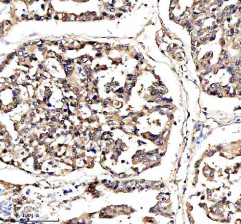 Immunohistochemical staining of DNAJB6 using anti-DNAJB6 antibody. DNAJB6 was detected in a paraffin