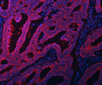 Immunofluorescent staining of FFPE human intestinal cancer tissue with EIF3A antibody (red) and DAPI
