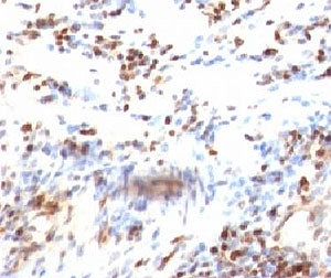 IHC: Formalin-fixed, paraffin-embedded human colon carcinoma stained with p27Kip1 antibody (clone KI