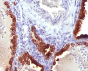 IHC testing of FFPE human lung carcinoma and Cytokeratin 7 antibody (clone CTKN7-1). Staining of for
