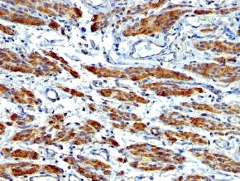 IHC: Formalin-fixed, paraffin-embedded human Leiomyosarcoma stained with SMMHC antibody (MYH11/923 +