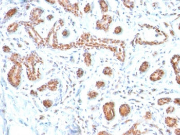 IHC testing of FFPE human breast carcinoma with GATA3 antibody. Required HIER: boil tissue sections