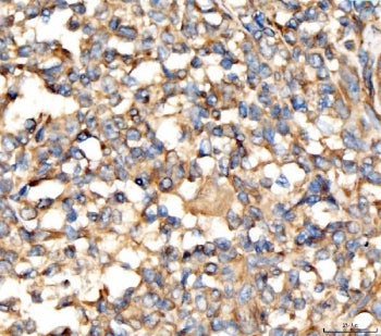 IHC staining of FFPE human lymphoma tissue with AP2A2 antibody. HIER: boil tissue sections in pH8 ED