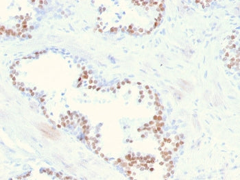 IHC staining of FFPE human prostate with NKX3.1 antibody. HIER: boil tissue sections in pH 9 10mM Tr