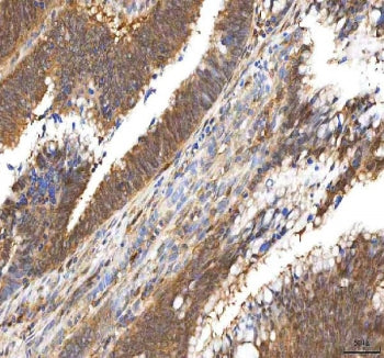 IHC staining of FFPE human colon adenocarcinoma tissue with Pyridoxal kinase antibody. HIER: boil ti
