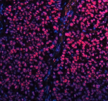 Immunofluorescent staining of FFPE human non-small cell carcinoma tissue with SP1 antibody (red) and