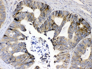 IHC testing of FFPE human intestinal cancer tissue with RPS6 antibody at 1ug/ml. Required HIER: stea